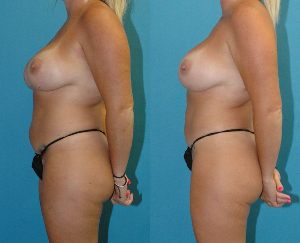 Mommy Makeover #30 - Before and After