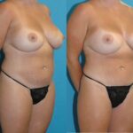 Mommy Makeover #30 - Before and After