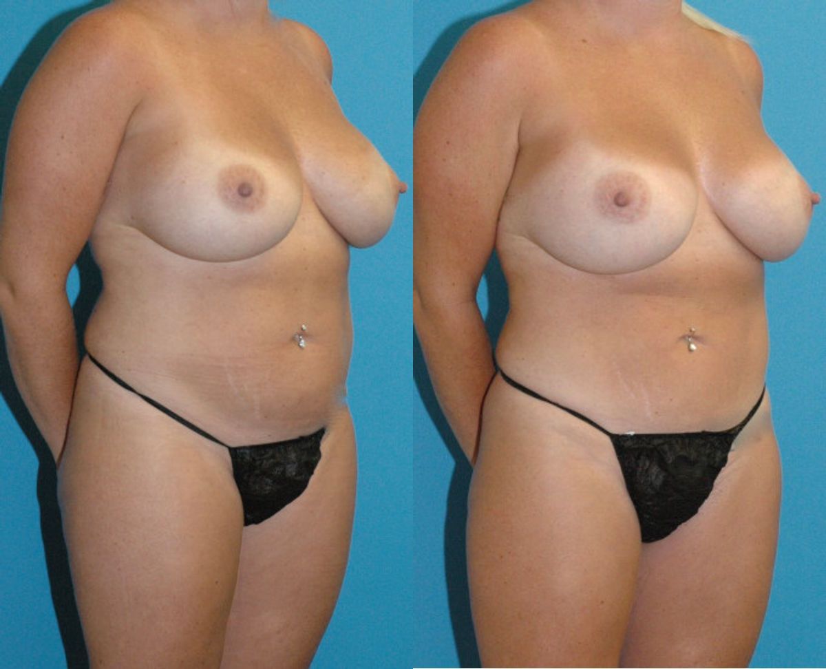 Mommy Makeover #30 - Before and After