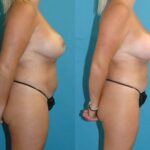 Mommy Makeover #30 - Before and After