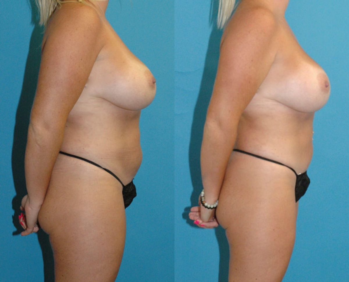 Mommy Makeover #30 - Before and After