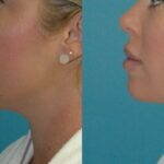 Mommy Makeover #30 - Before and After