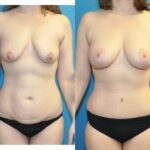 Mommy Makeover #31 - Before and After