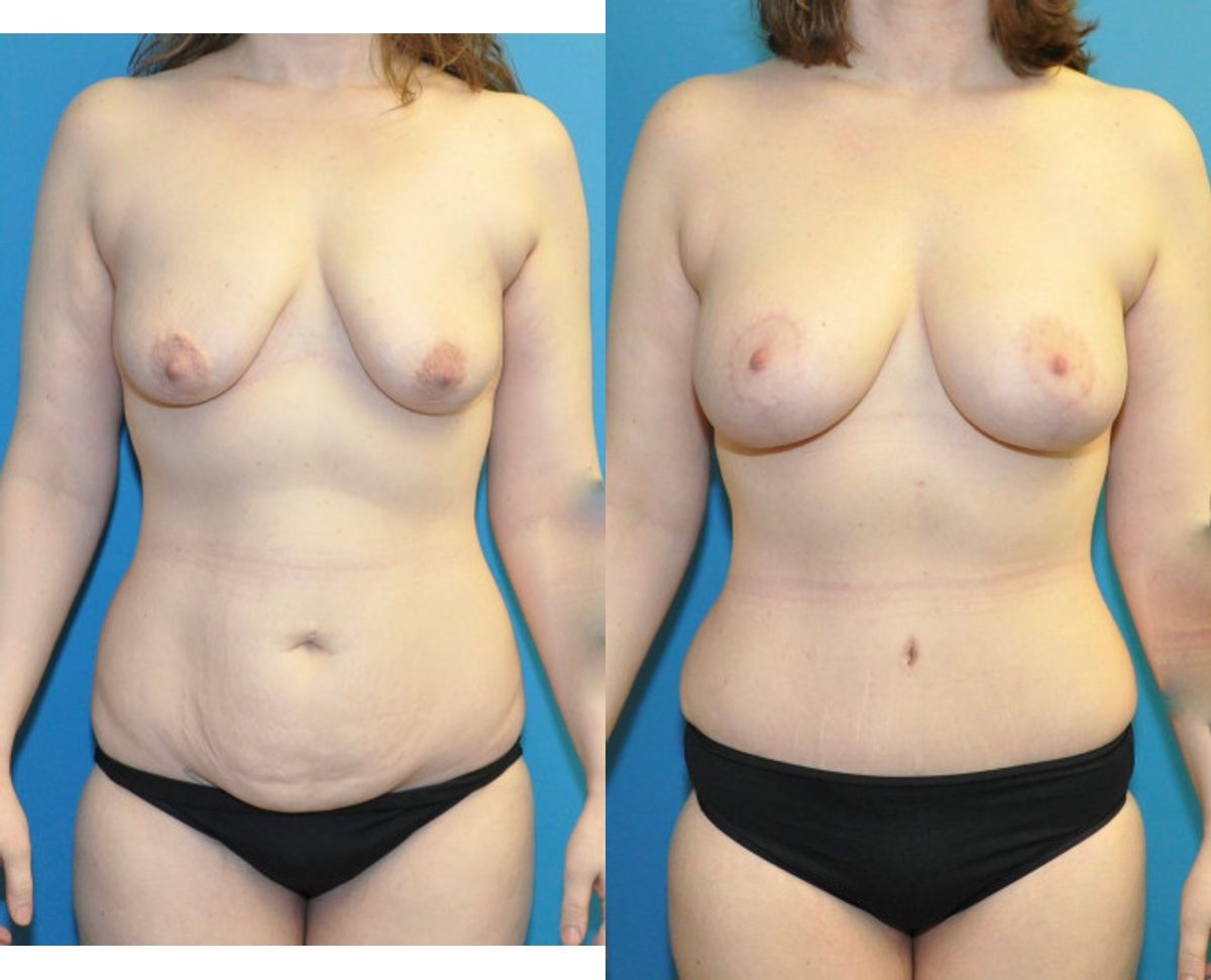 Mommy Makeover #31 - Before and After