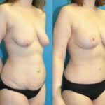 Mommy Makeover #31 - Before and After