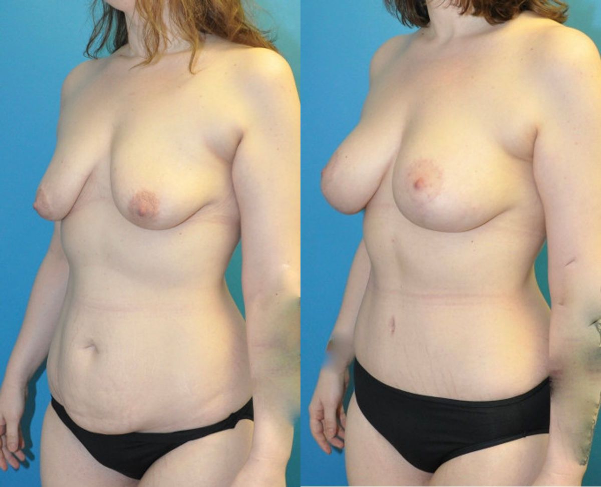 Mommy Makeover #31 - Before and After