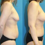 Mommy Makeover #31 - Before and After