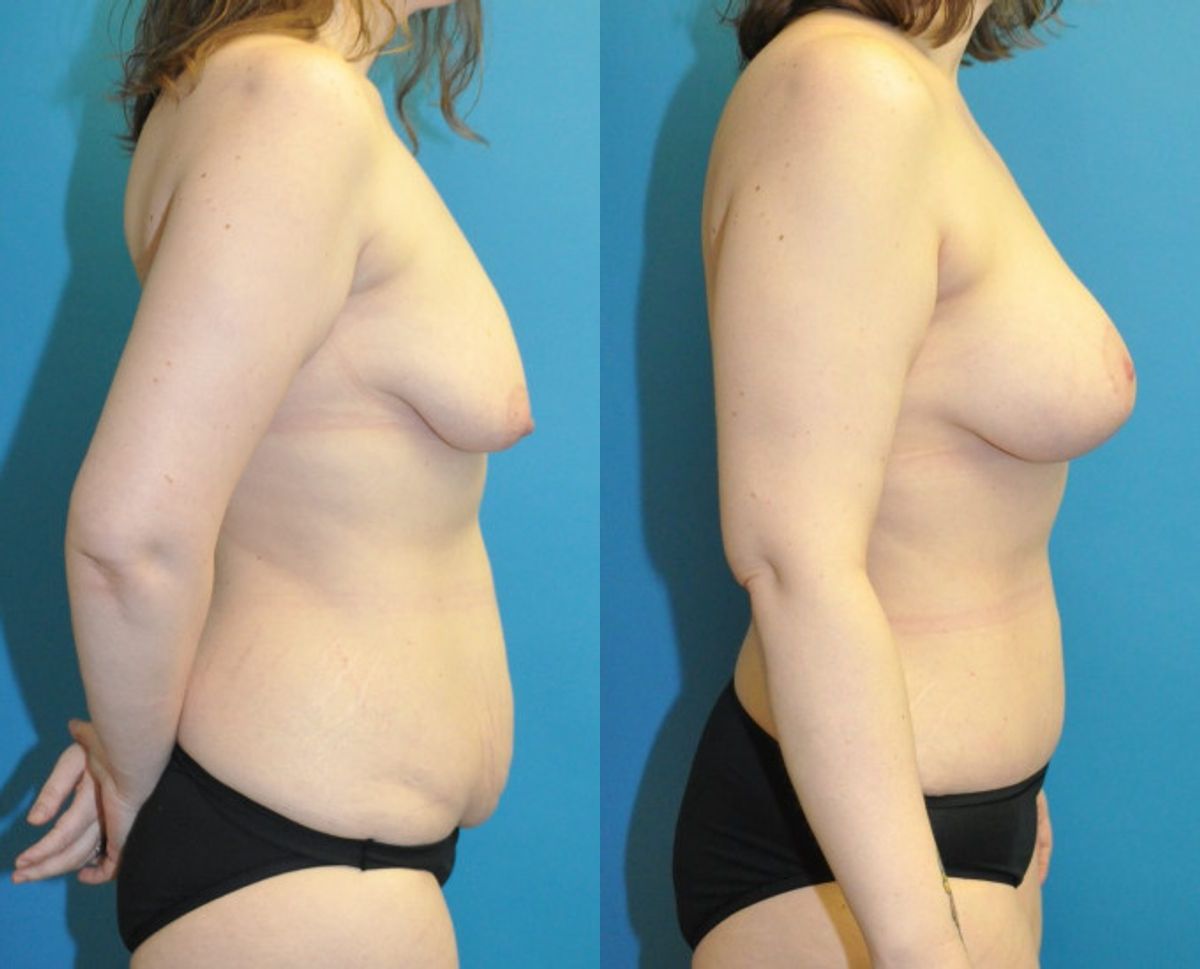 Mommy Makeover #31 - Before and After