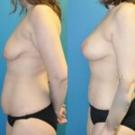 Mommy Makeover #31 - Before and After