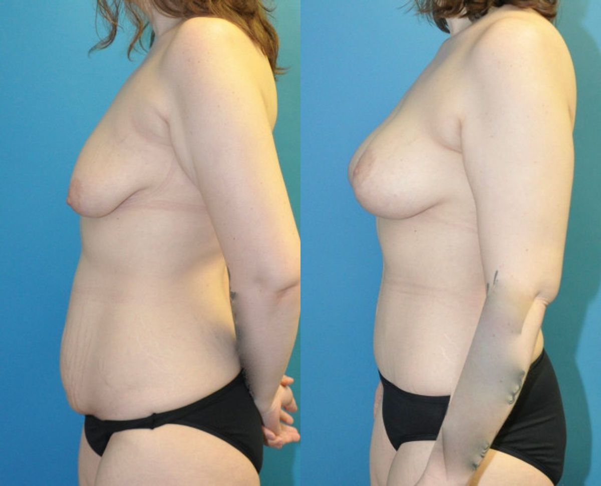 Mommy Makeover #31 - Before and After