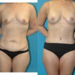 Mommy Makeover #32 - Before and After