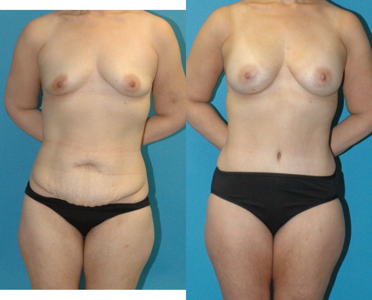 Mommy Makeover #32 - Before and After