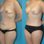 Mommy Makeover #32 - Before and After