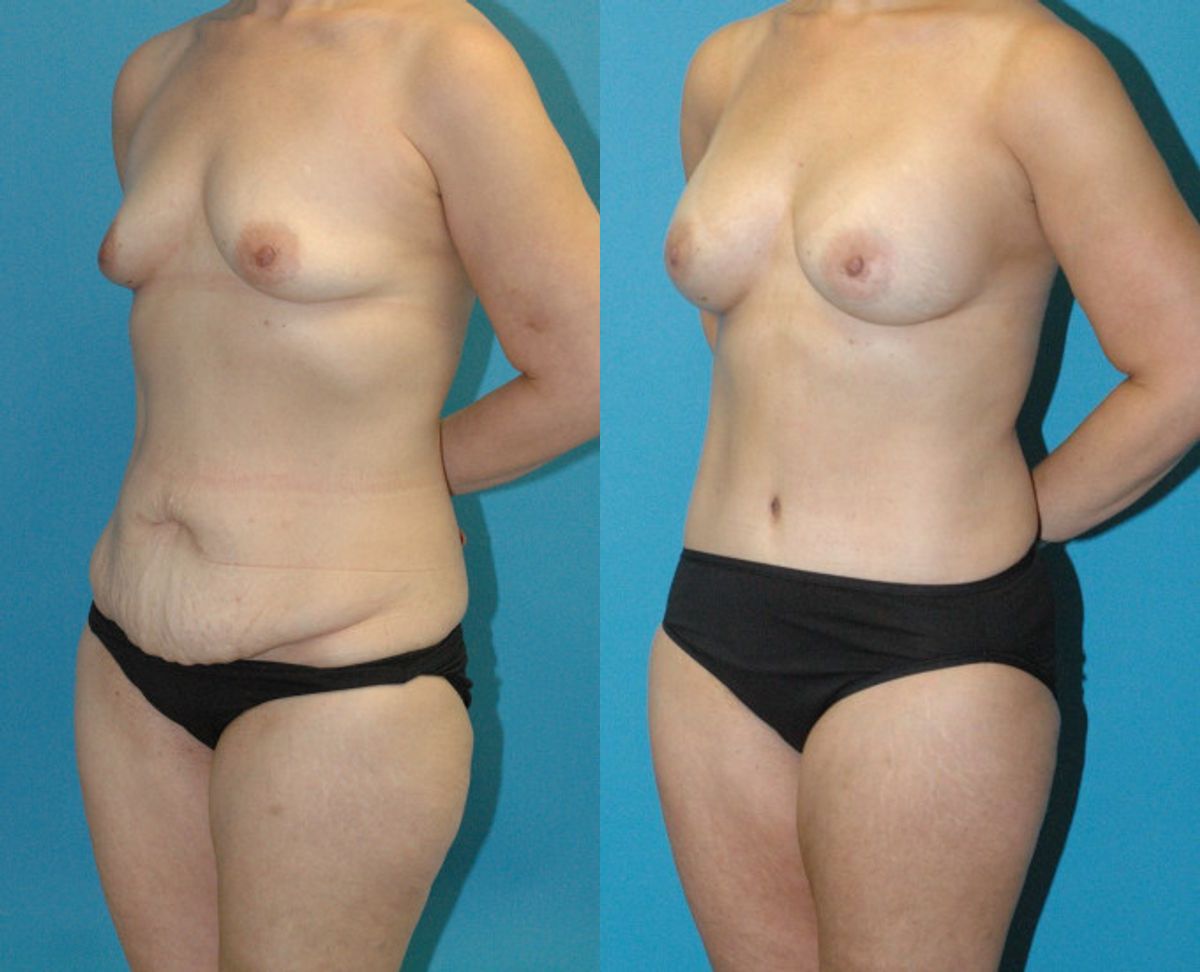 Mommy Makeover #32 - Before and After