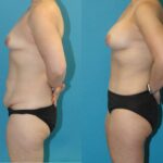 Mommy Makeover #32 - Before and After