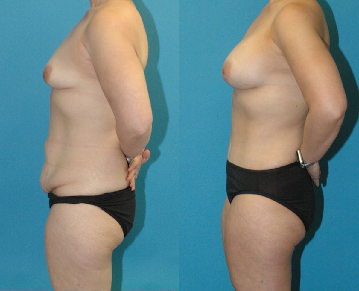 Mommy Makeover #32 - Before and After