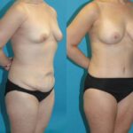 Mommy Makeover #32 - Before and After