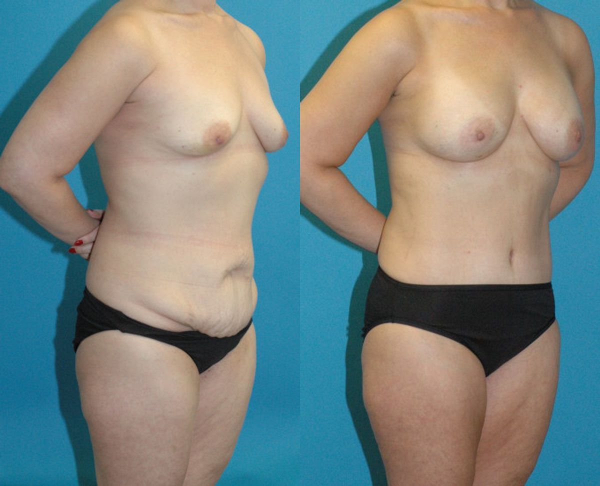 Mommy Makeover #32 - Before and After