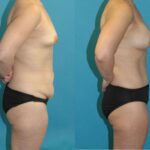 Mommy Makeover #32 - Before and After