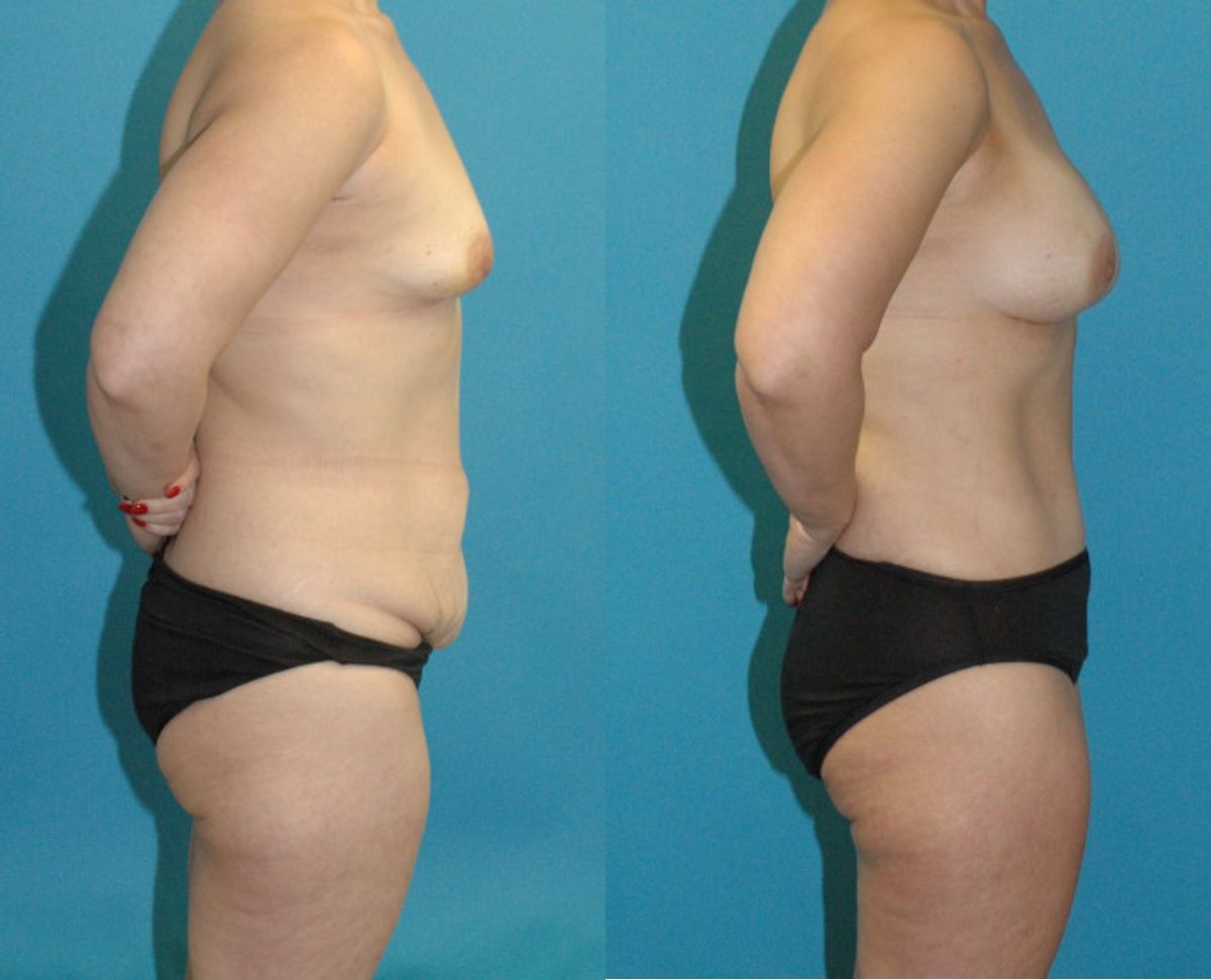 Mommy Makeover #32 - Before and After