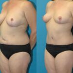 Mommy Makeover #33 - Before and After