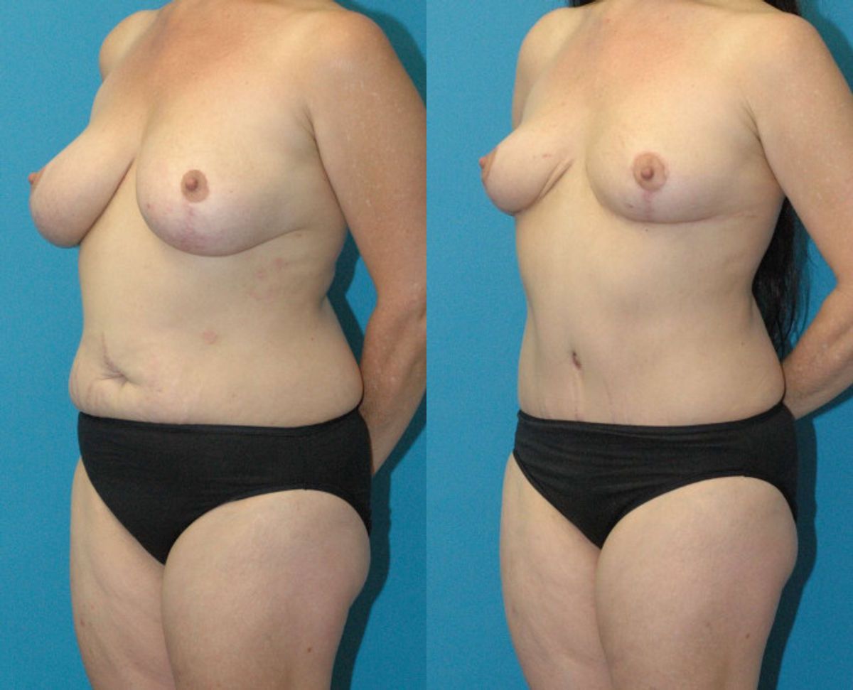 Mommy Makeover #33 - Before and After