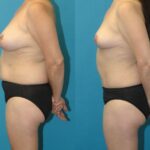 Mommy Makeover #33 - Before and After