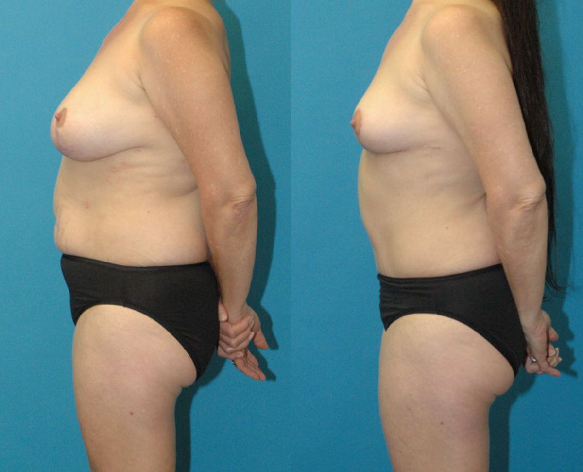 Mommy Makeover #33 - Before and After