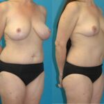 Mommy Makeover #33 - Before and After