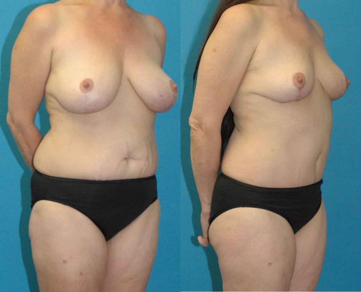 Mommy Makeover #33 - Before and After