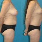 Mommy Makeover #33 - Before and After