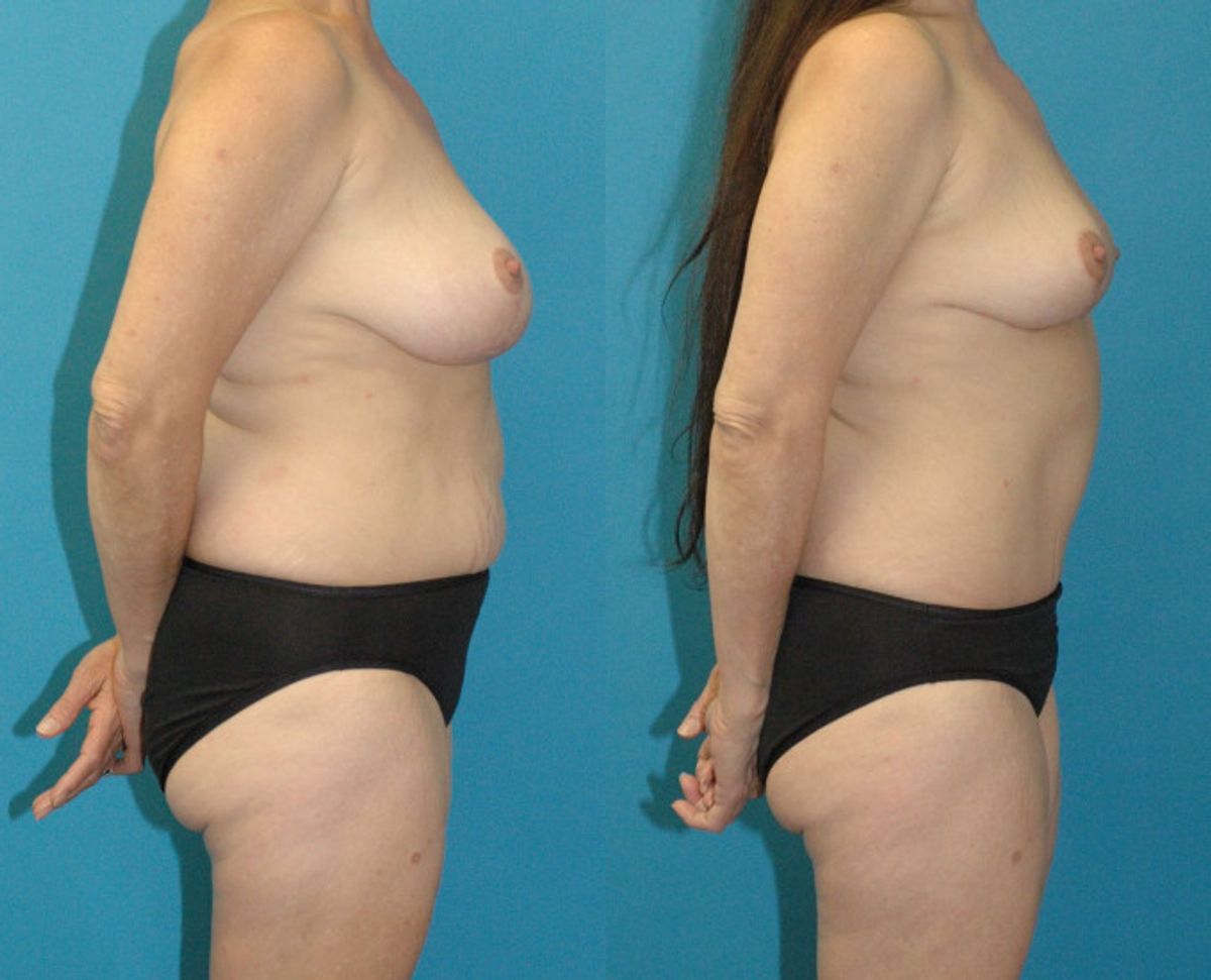 Mommy Makeover #33 - Before and After