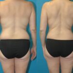 Mommy Makeover #33 - Before and After