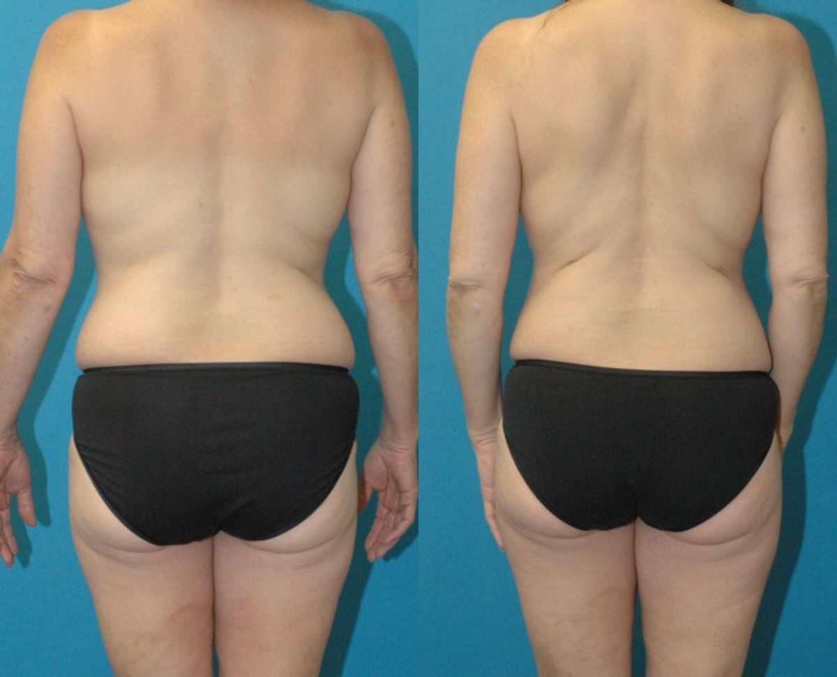 Mommy Makeover #33 - Before and After