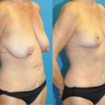 Mommy Makeover #34 - Before and After