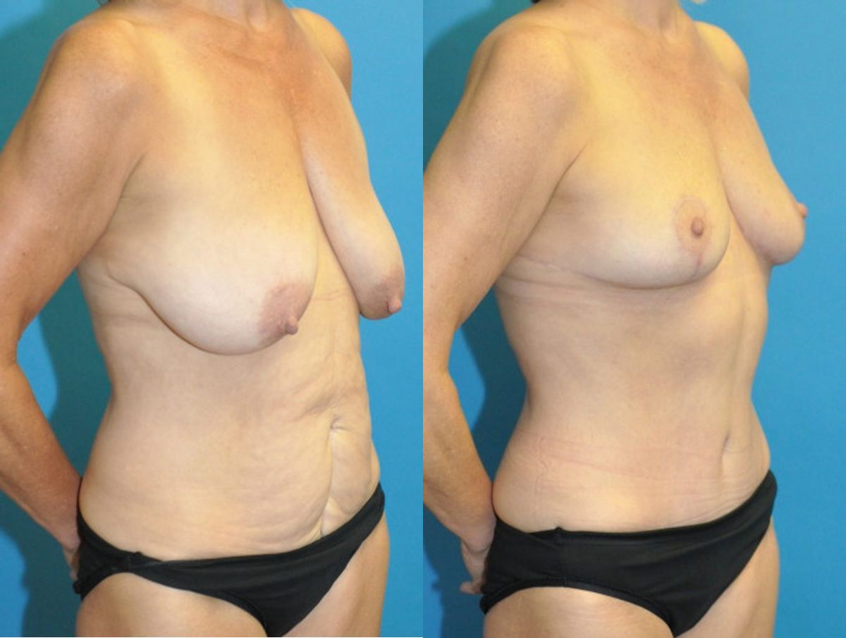 Mommy Makeover #34 - Before and After