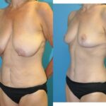 Mommy Makeover #34 - Before and After