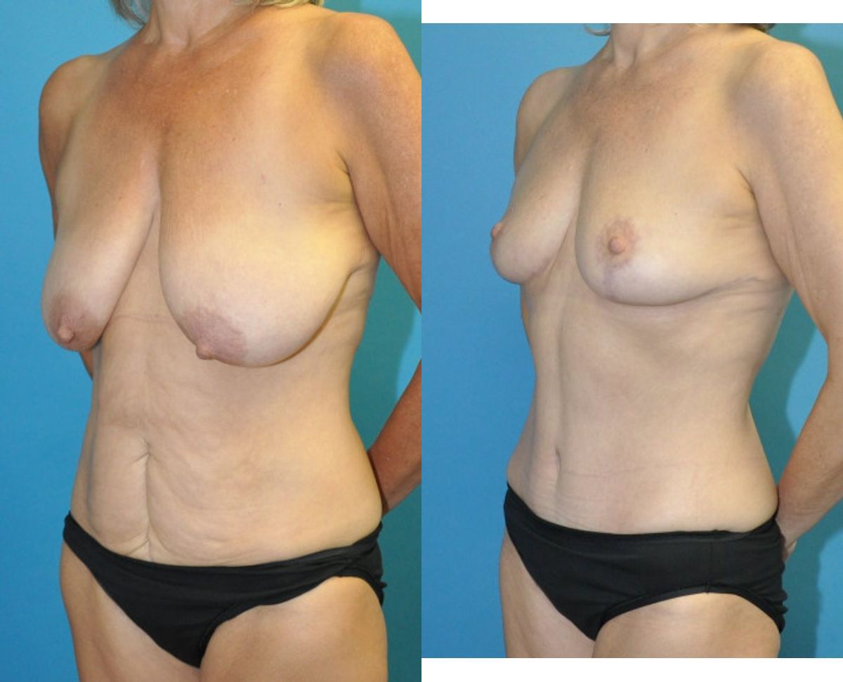 Mommy Makeover #34 - Before and After