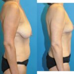 Mommy Makeover #34 - Before and After