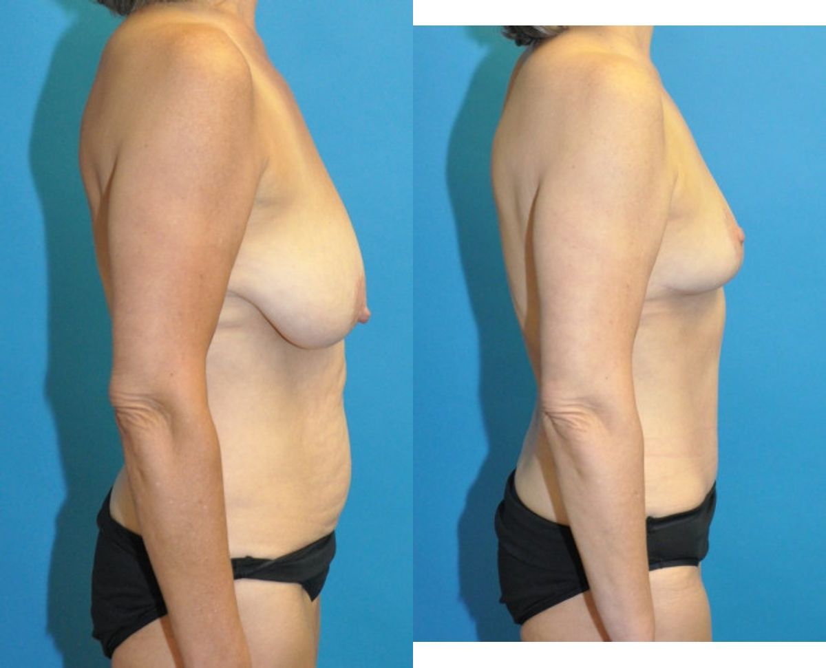 Mommy Makeover #34 - Before and After