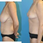 Mommy Makeover #34 - Before and After