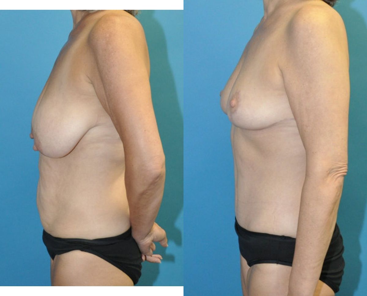 Mommy Makeover #34 - Before and After