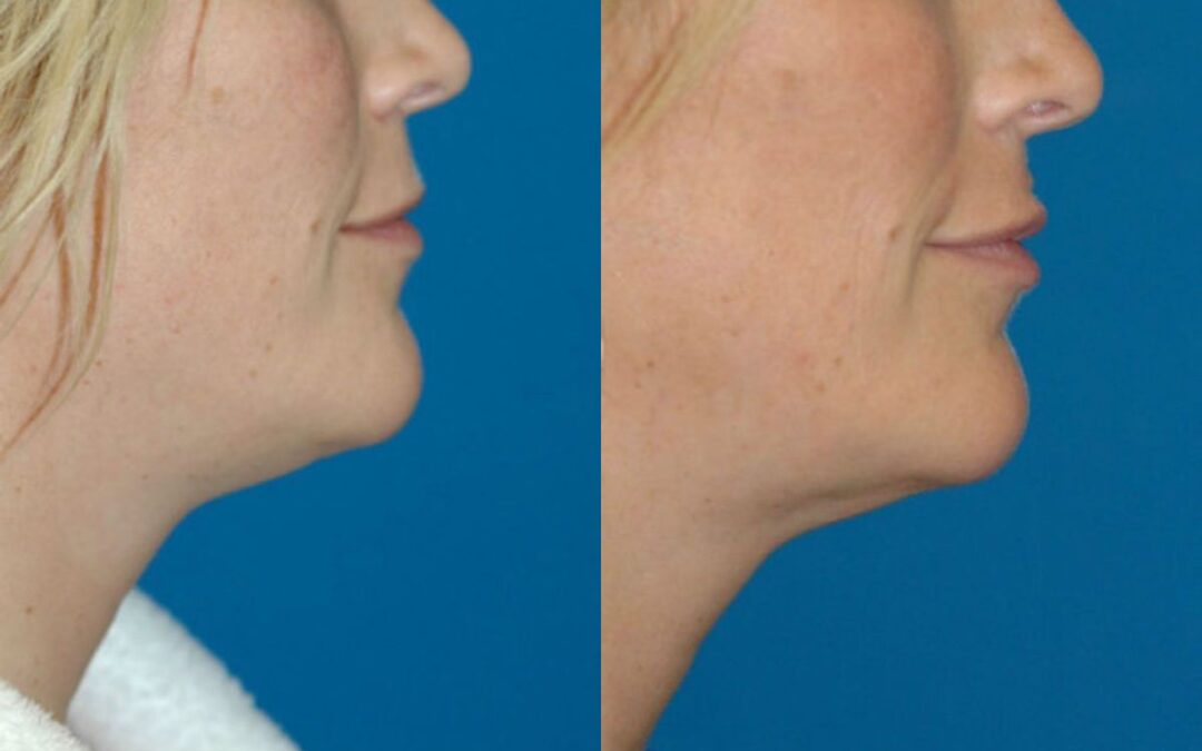 Neck Liposuction #1
