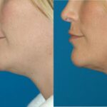Neck Liposuction #1 - Before and After