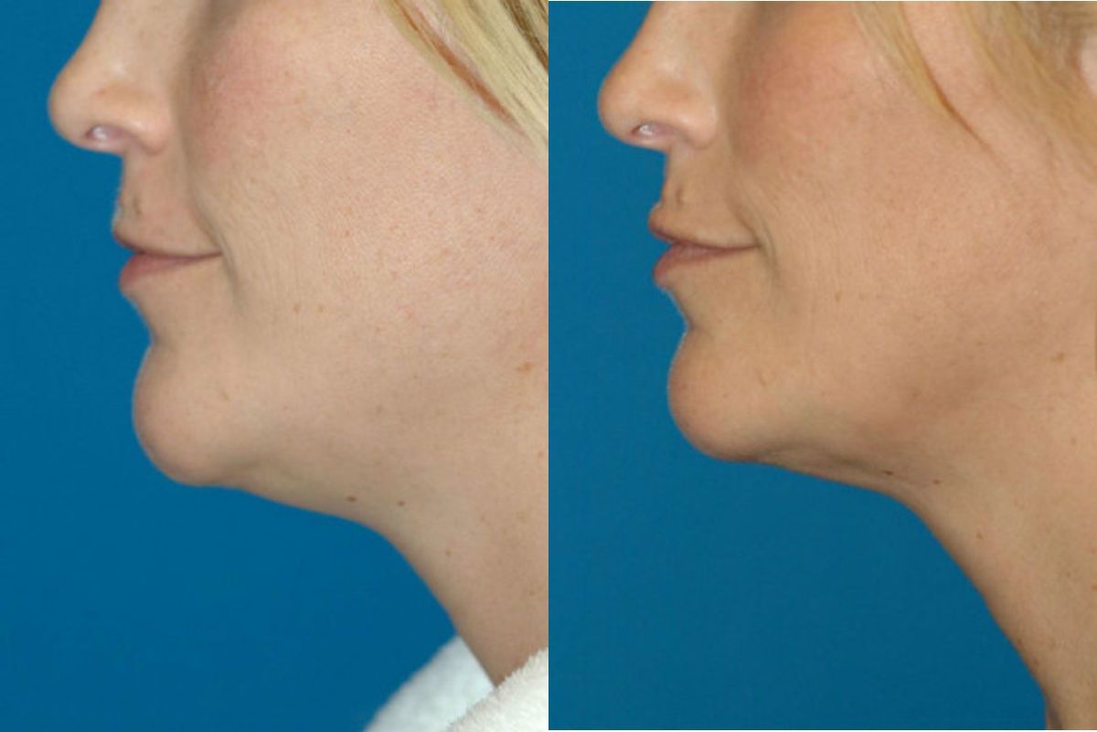 Neck Liposuction #1 - Before and After