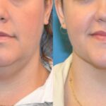 Neck Liposuction #2 - Before and After