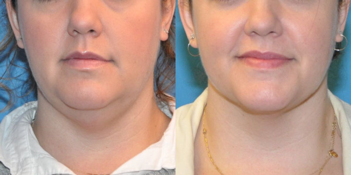 Neck Liposuction #2 - Before and After