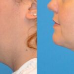 Neck Liposuction #2 - Before and After