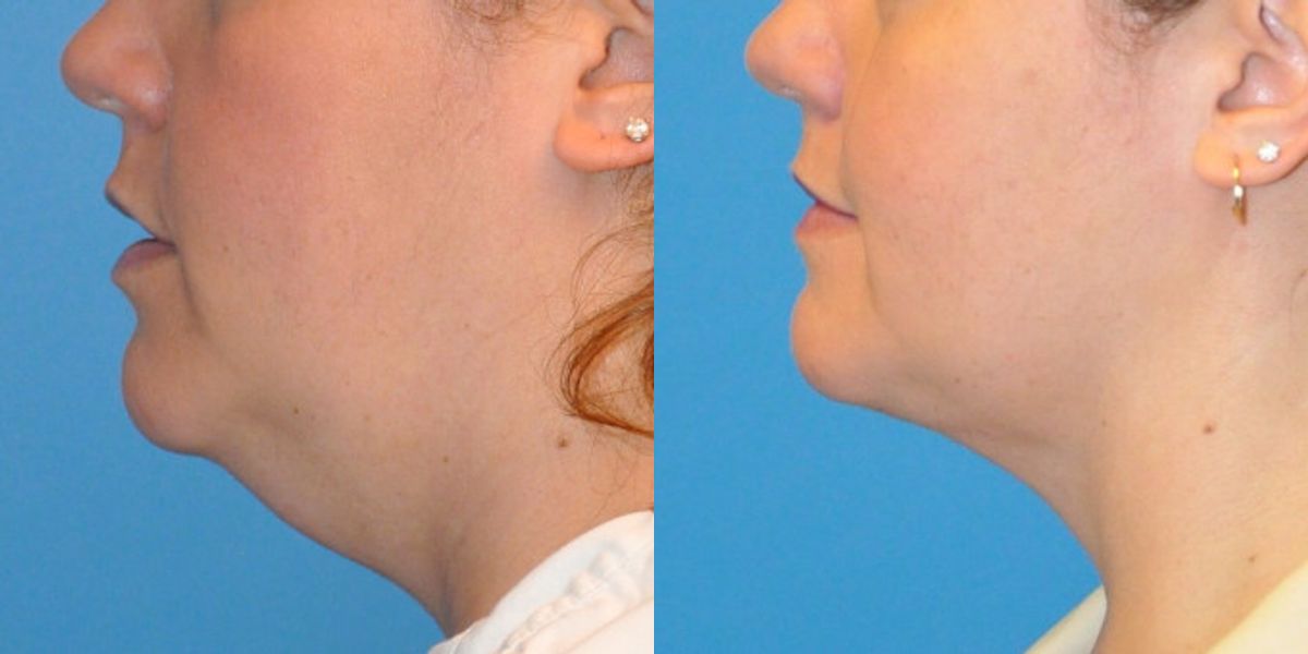 Neck Liposuction #2 - Before and After