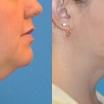 Neck Liposuction #2 - Before and After